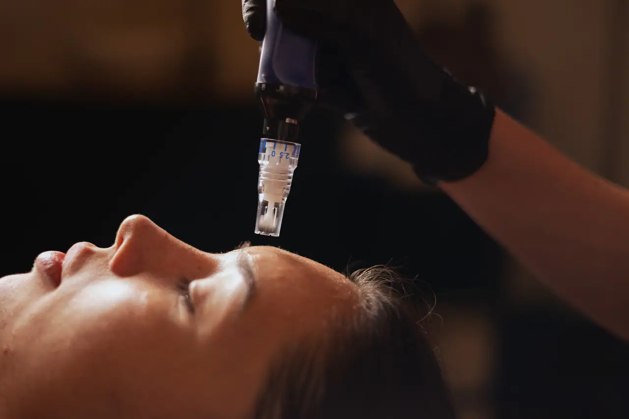 Mezoterapia mikroigłowa – Mento Care Bochnia